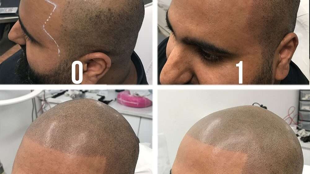 découvrez la repigmentation capillaire, une technique innovante pour redonner couleur et vitalité à vos cheveux, en restaurant leur pigment naturel de manière durable et naturelle.