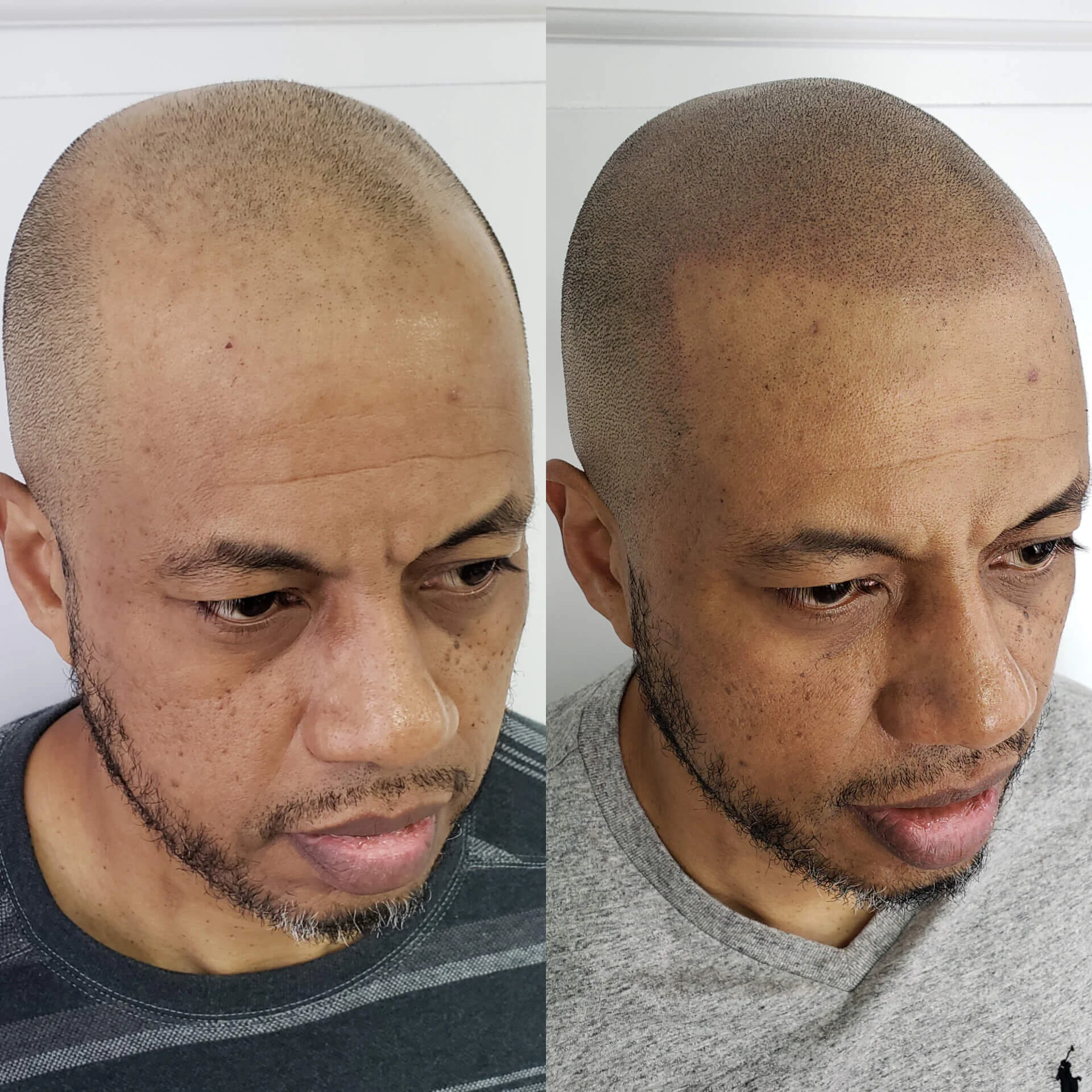 découvrez la repigmentation capillaire, une technique innovante pour restaurer naturellement la couleur de vos cheveux et retrouver une chevelure éclatante et jeune.